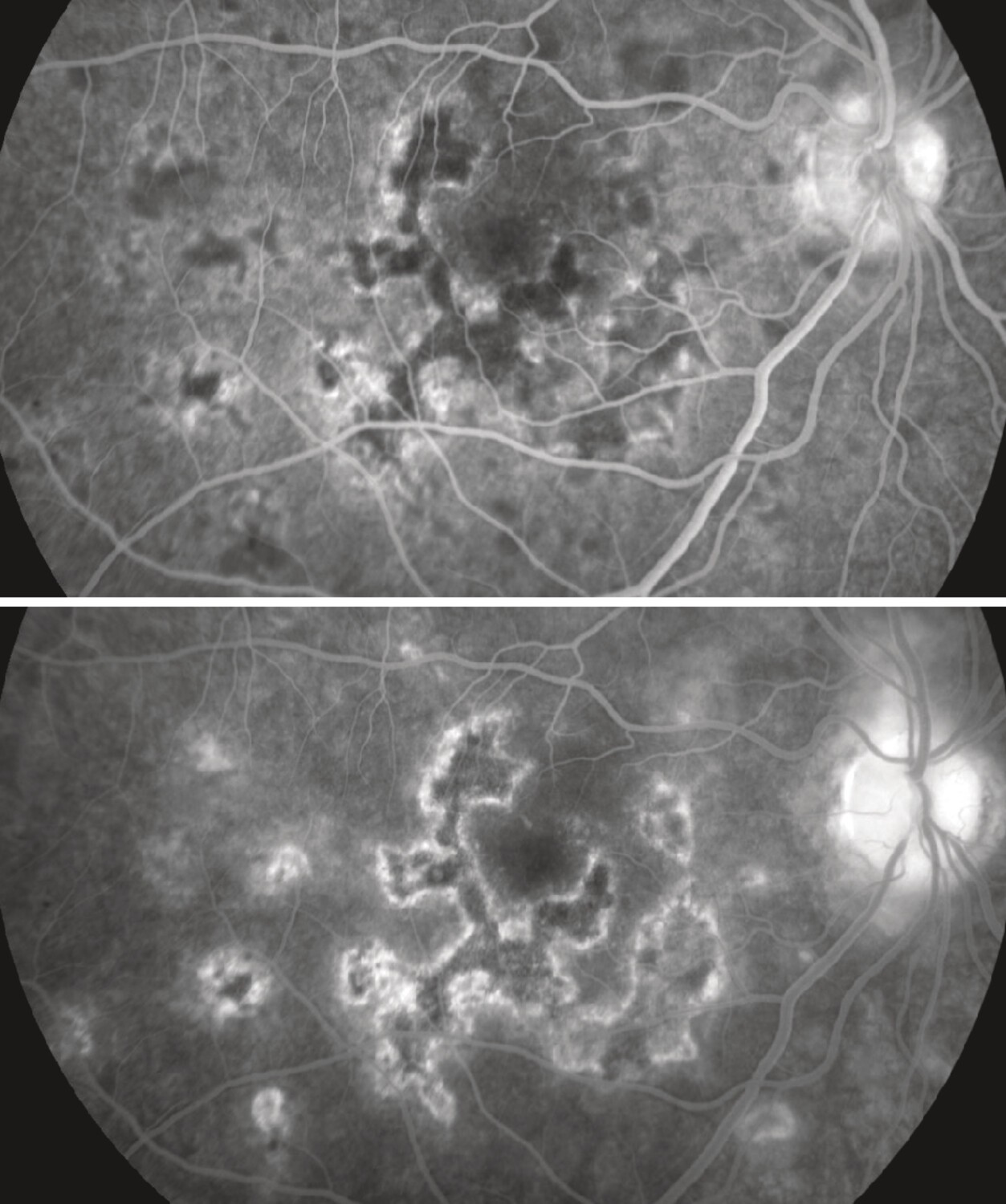 Angiographie à la fluorescéine