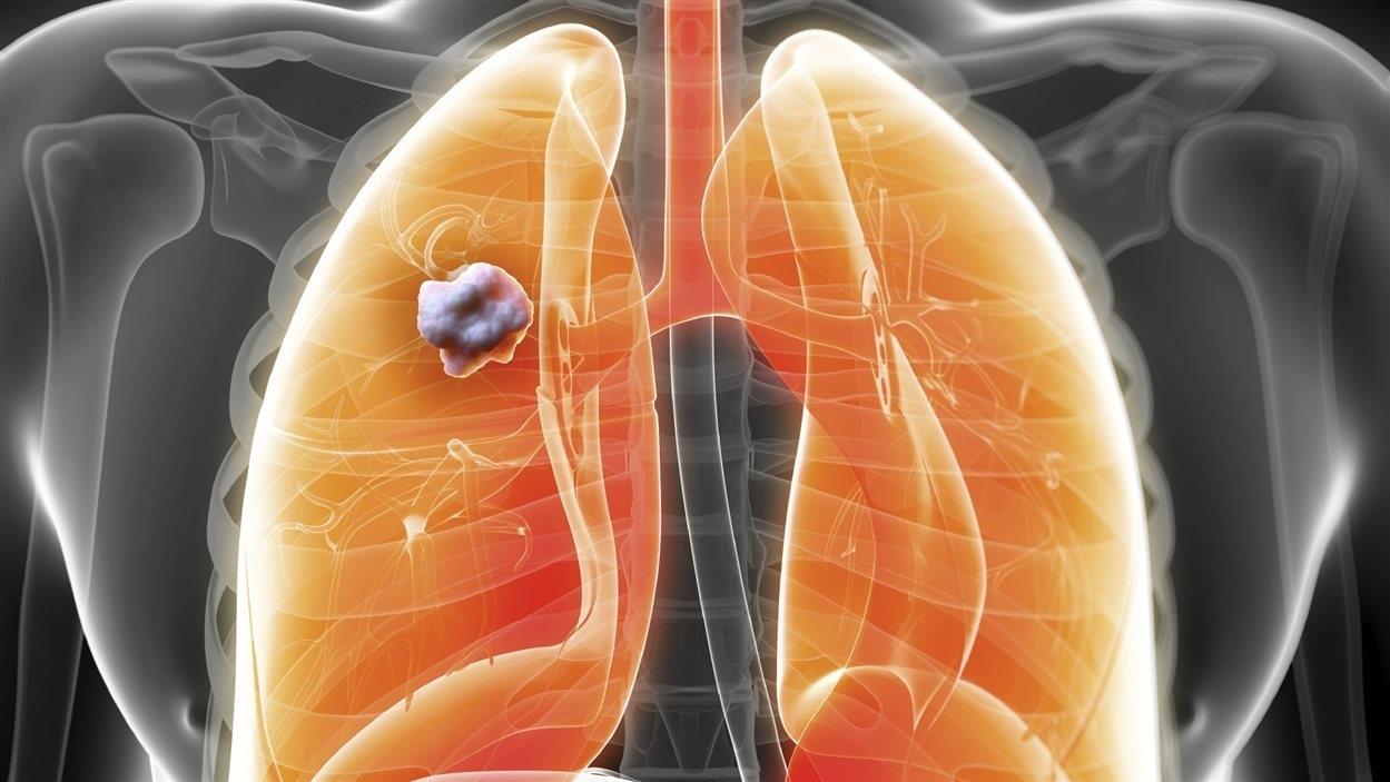 Carcinome du poumon