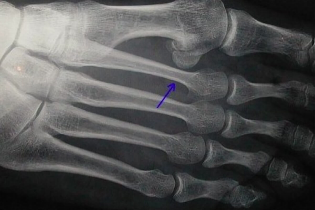 fractures osseuses