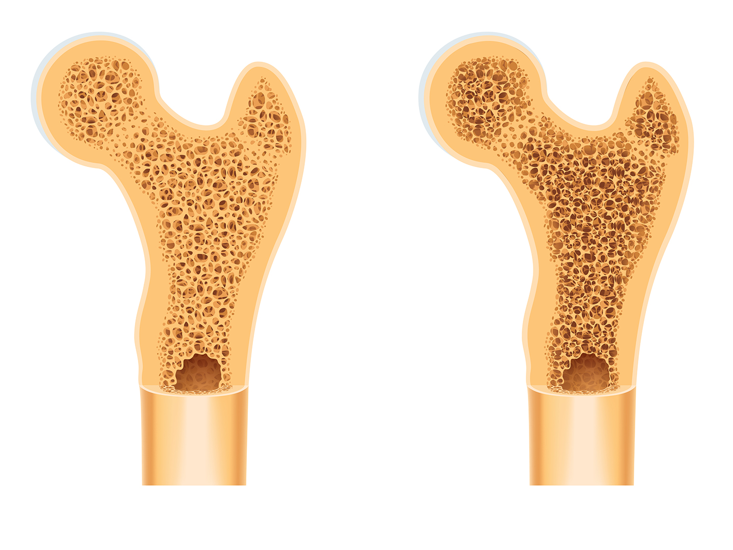 osteoporose